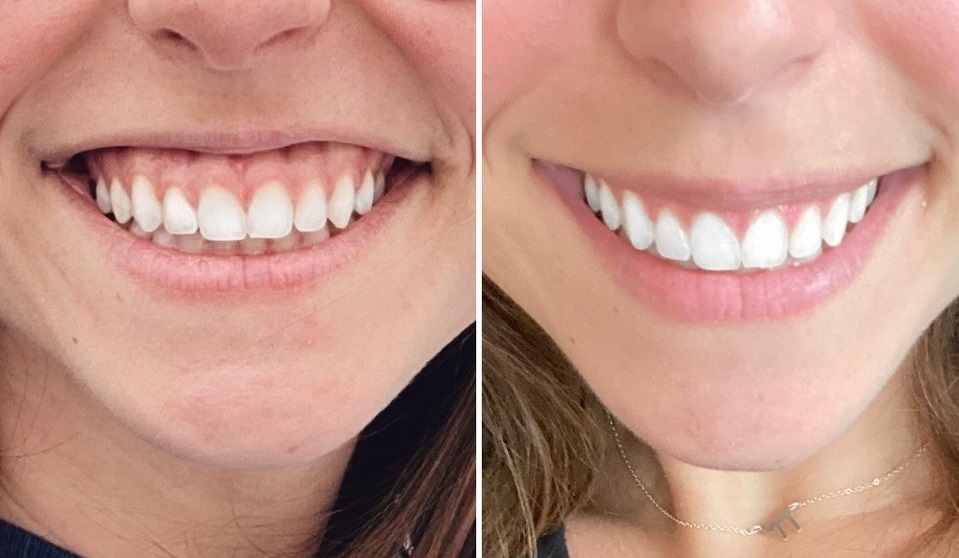 Gummy Smile Botox A Revolutionary Cosmetic Treatment